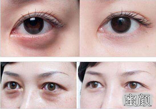 科技揭秘，最新去眼袋最佳方法，重塑眼部美麗新篇章！