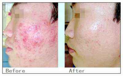 激光祛疤價格詳解，深度解析與觀點闡述