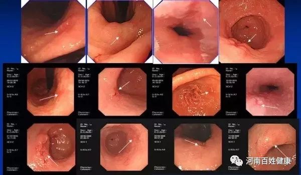 最新胃腸鏡技術(shù)，醫(yī)學(xué)領(lǐng)域的革新之星