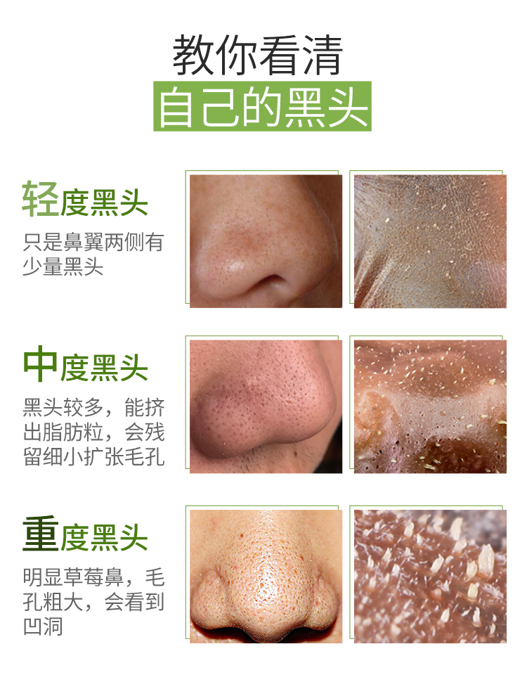 最新去黑頭教程視頻匯總，科技助力美麗重塑，黑頭無(wú)憂新篇章