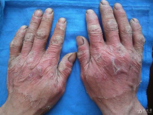 失禁性皮炎最新分期，智能照護(hù)助力重塑生活品質(zhì)